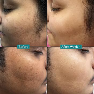 Chemist at play Vitamin C serum - Reduce Ance & dark spots and Brighten skin tone in just 7 days