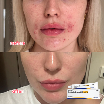 Tretinoin Cream USP